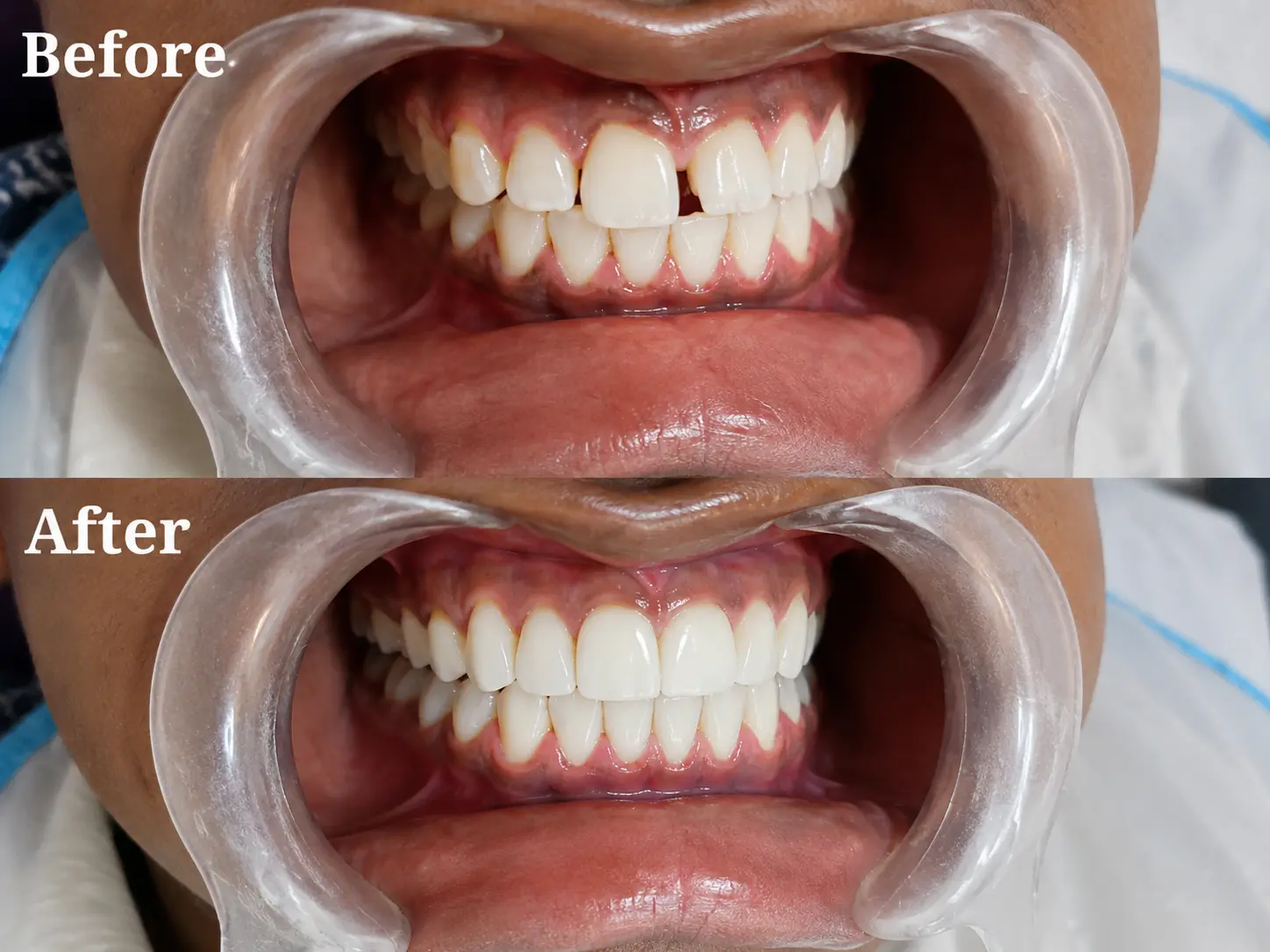 Before and After results at Dr Soujanya's clinic, Thiruverumbur — General Dentistry