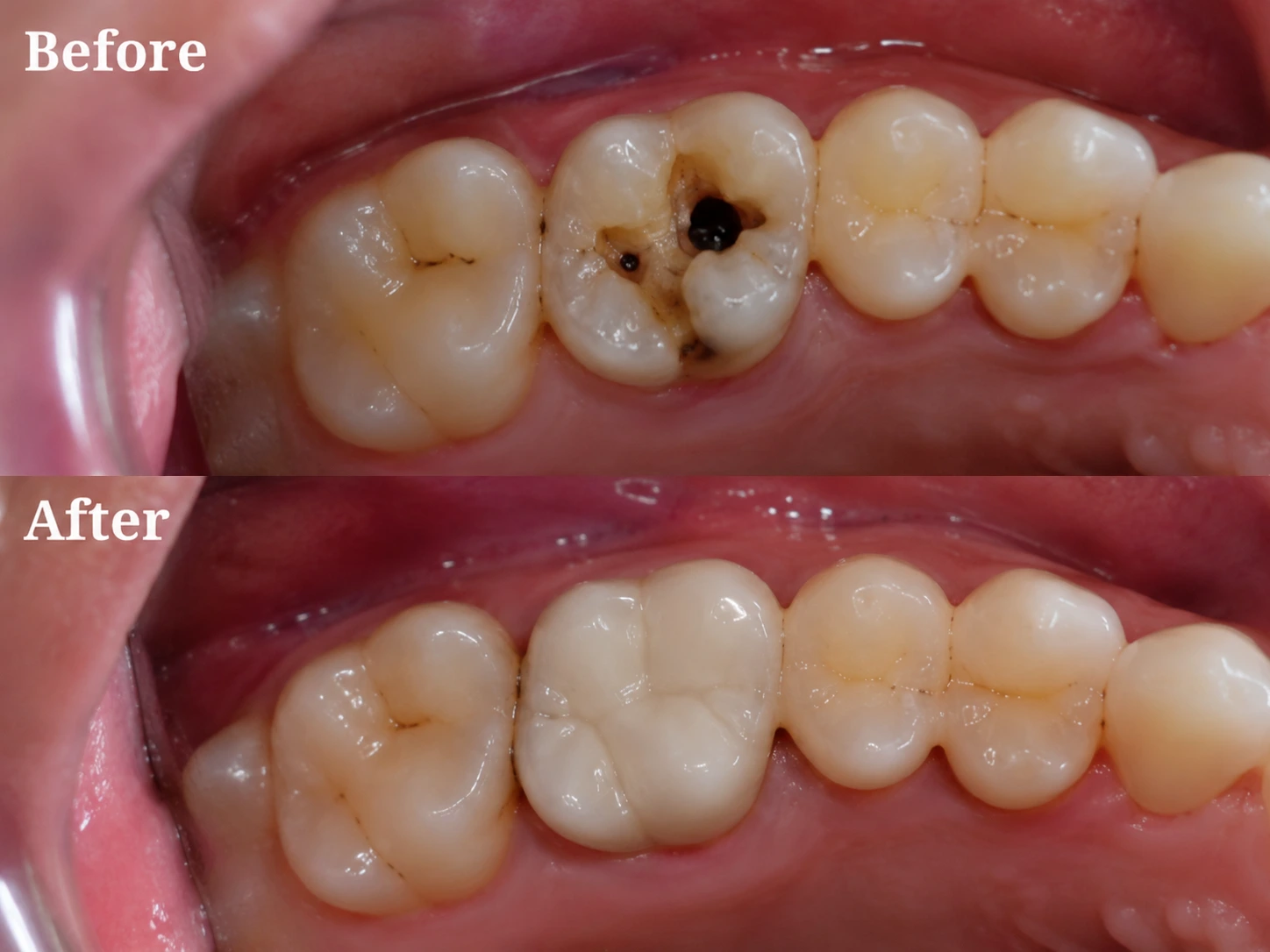 Before and After results at Dr Soujanya's clinic, Thiruverumbur — Root Canal