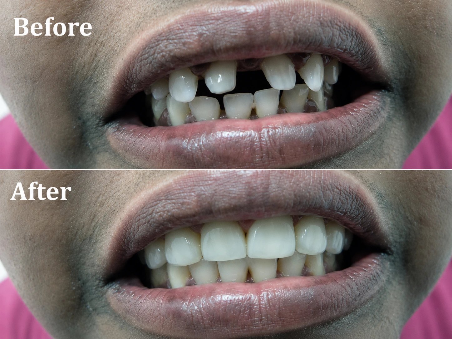 Before and After results at Dr Soujanya's clinic, Thiruverumbur — Smile Designing