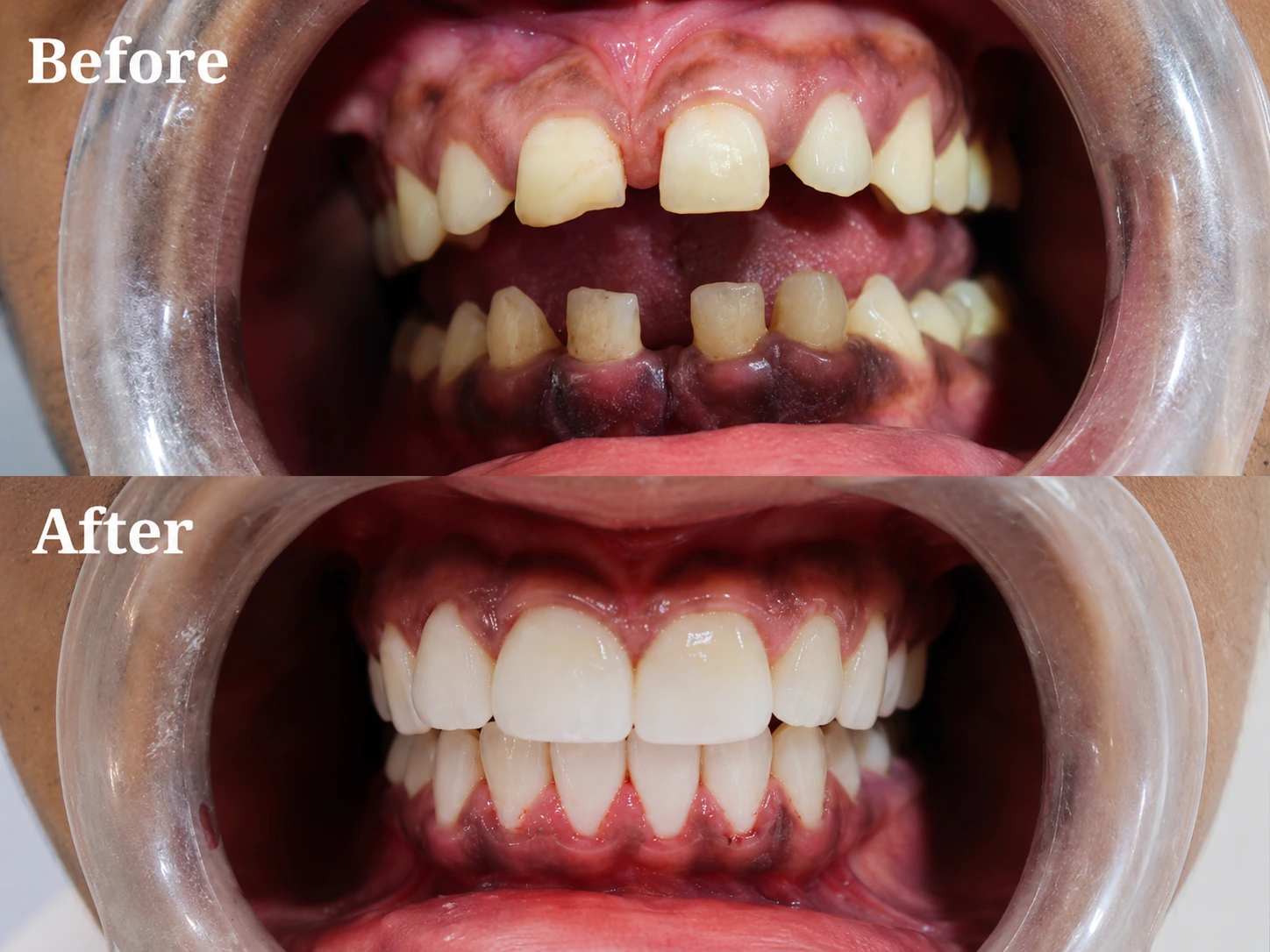 Before and After results at Dr Soujanya's clinic, Thiruverumbur — Teeth Alignment